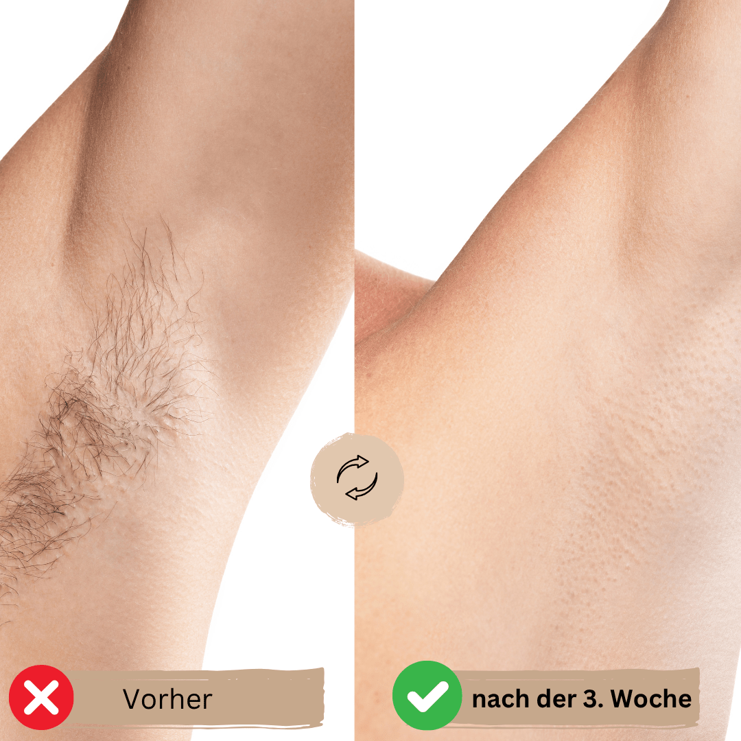 GlowSkin - IPL Haarentfernungsgerät - dauerhafte Haarentfernung, schmerzfrei & sicher - für sensible Haut & alle Körperbereiche - épure paris