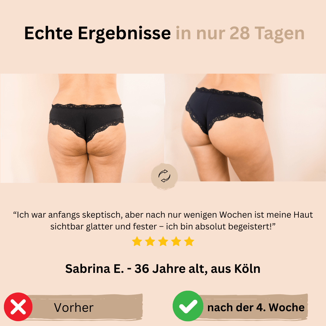 LymphLift Pro - 5 - in - 1 Anti - Cellulite - Massagegerät - gegen Wassereinlagerungen, Cellulite & schlaffe Haut - Fördert Fettverbrennung - Lymphdrainage & Körperformung - épure paris